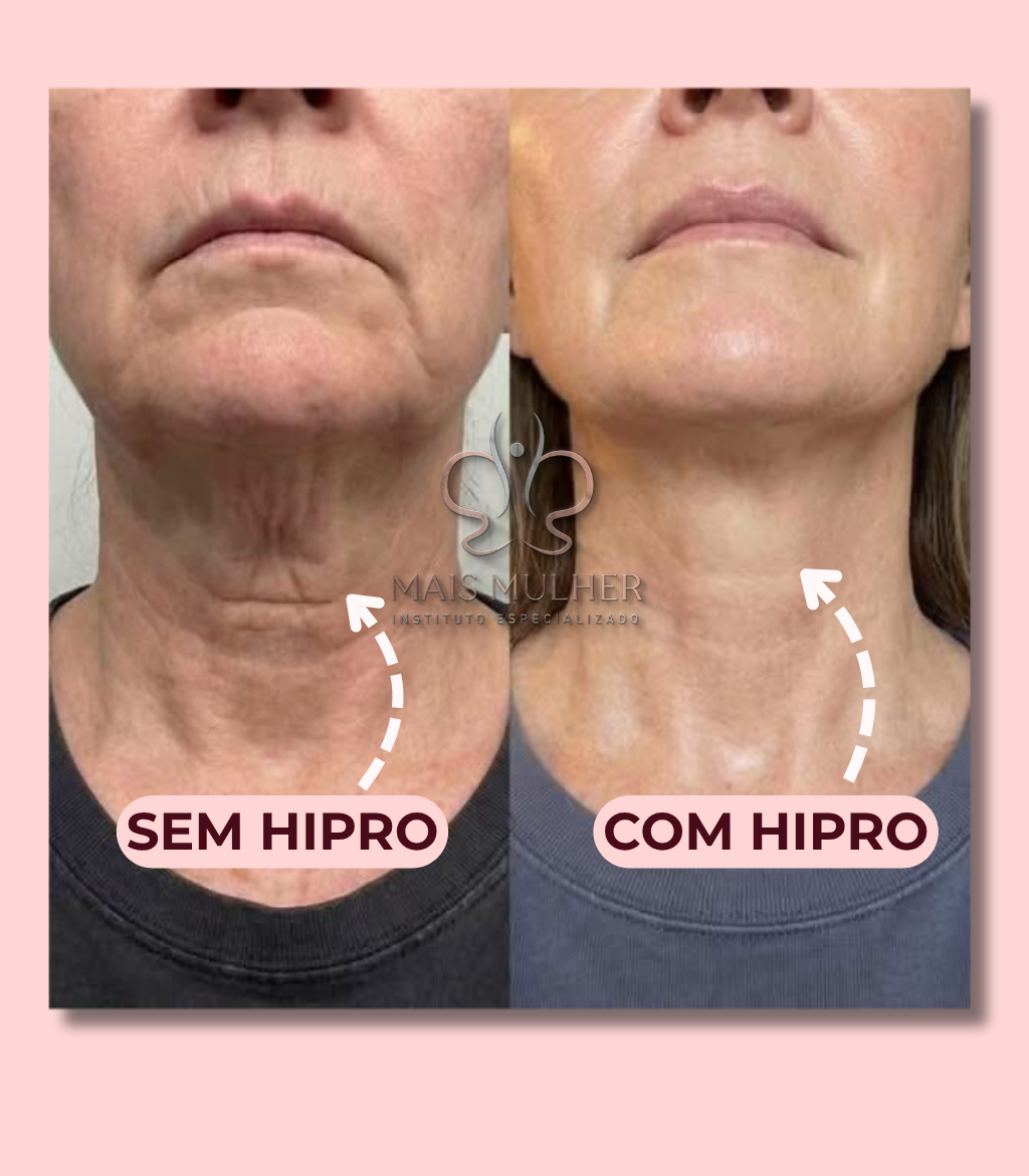 Antes e depois identificado como sem Hipro e com Hipro na região do pescoço