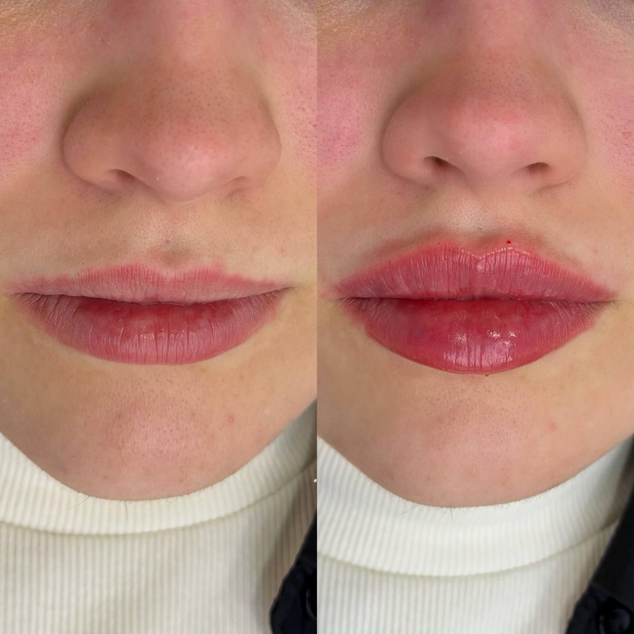 Antes e depois frontal mostrando maior definição dos lábios