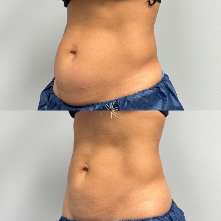 Antes e depois corporal mostrando mudança visível no contorno abdominal